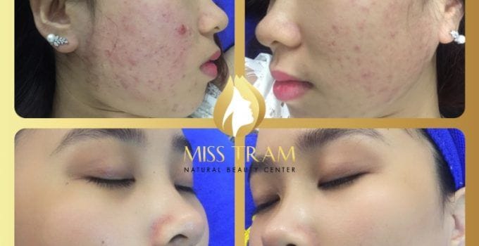 Thẩm mỹ viện Miss Trâm (Miss Tram – Natural Beauty Center)
